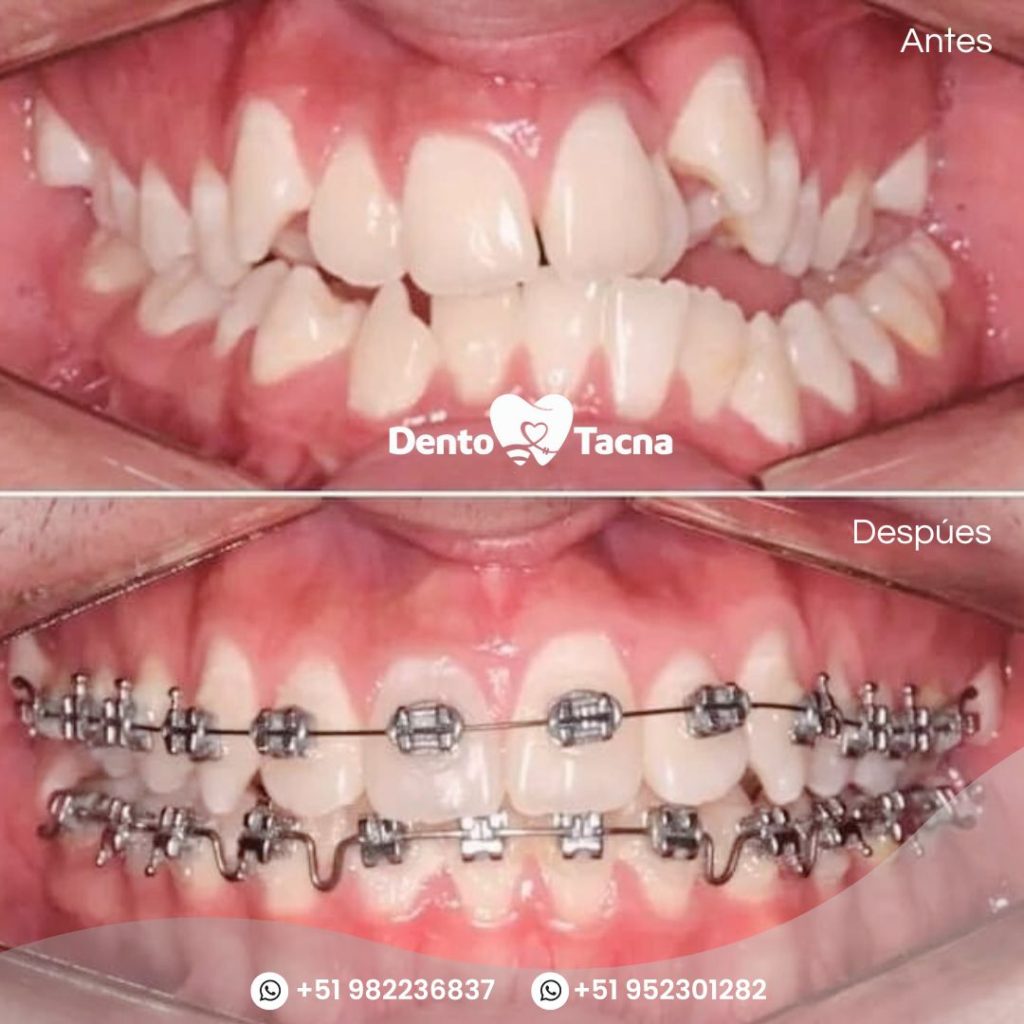 Brackets 8